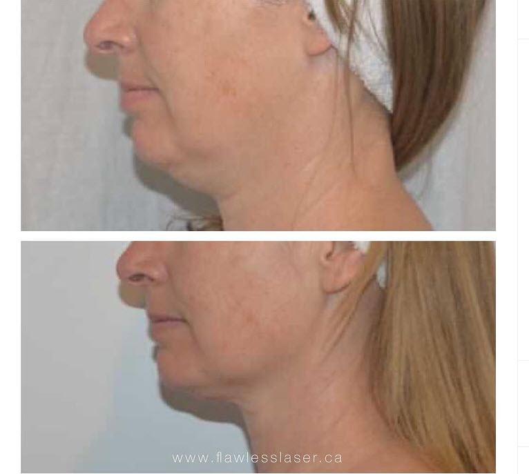 Skin tightening to reduce double chin